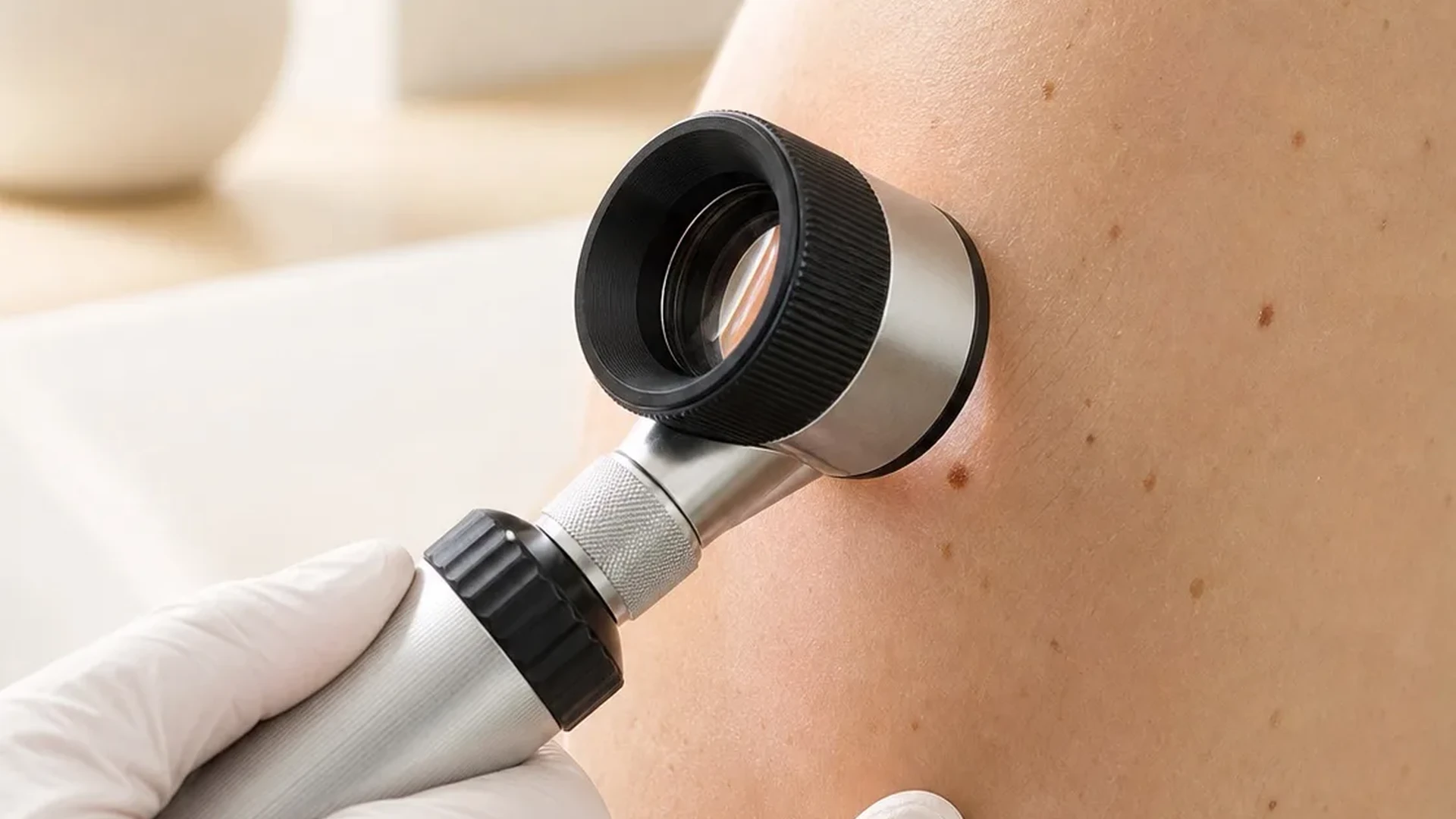 Evaluación cercana de lunares con dermatoscopio